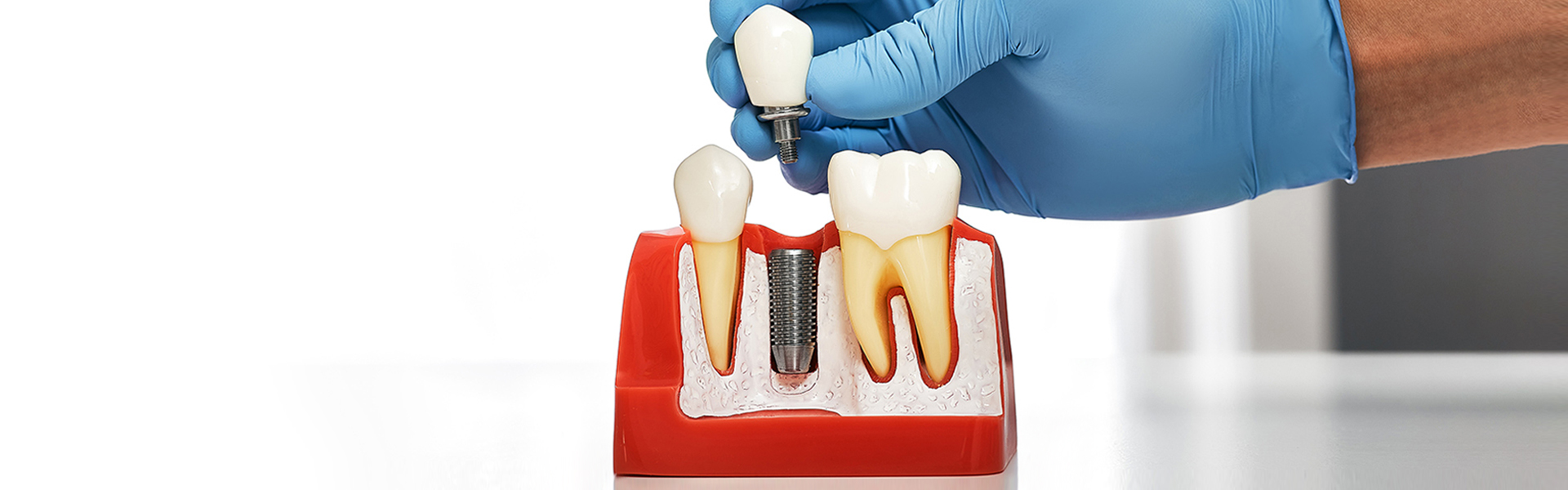 Types of Dental Implants Available in Tampa: Which One is Right for You?